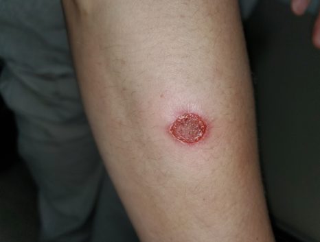 인수공통감염 사례 – 반려동물의 피부사상균이 옮아 보호자 팔에 생긴 동그란 붉은 테두리 병변